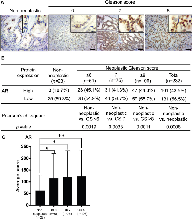AR expression is increased in human prostate cancer tissues compared to non-neoplastic prostate tissues.