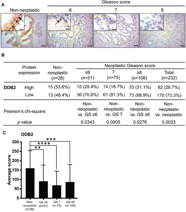DDB2 expression is decreased in human prostate cancer tissues compared to non-neoplastic prostate tissues.