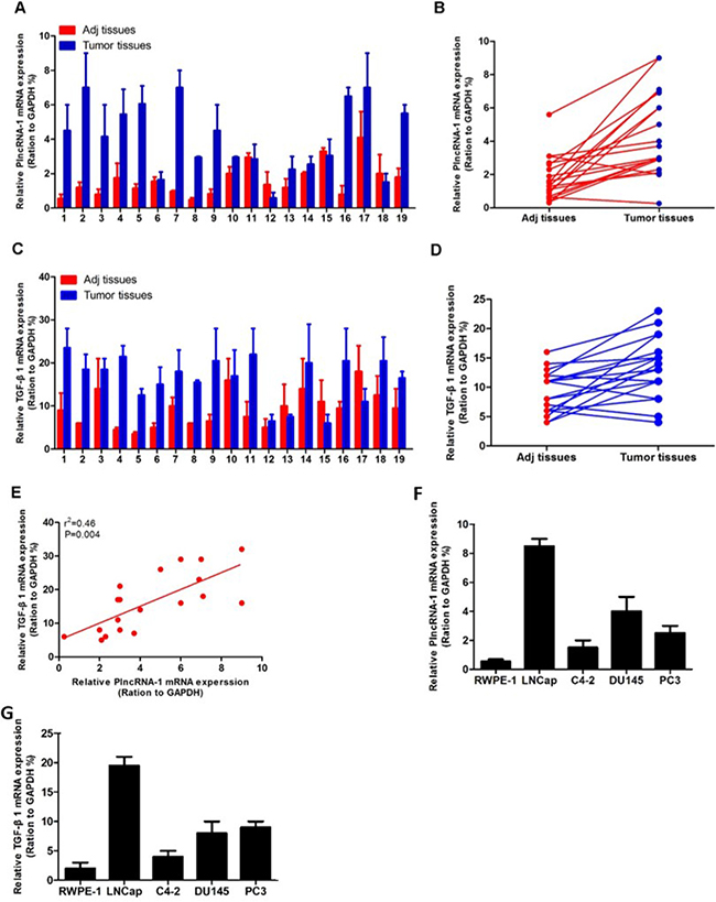 Expression of PlncRNA-1 and TGF-&#x03B2;1 in prostate cancer and correlation analysis.