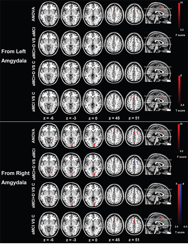 Group differences of effective connectivity based on the seed of right and left amygdala.