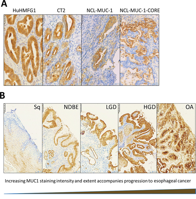 Immunohistochemical staining patterns with anti-MUC1 antibodies in high grade dysplasia and HuHMFG1 staining in the squamous-metaplasia-dysplasia-carcinoma sequence.