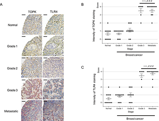 Expression of TOPK or TLR4 is highly increased in high-grade breast cancer.