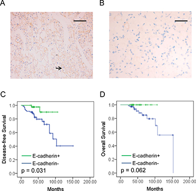 E-cadherin expression and prognosis value in RCC.