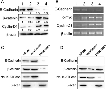 Correlation between E-cadherin and WNT/&#x03B2;-catenin signaling in RCC tissues.