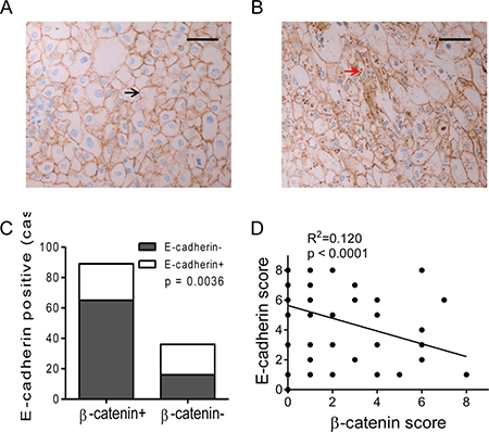 Expression of &#x03B2;-catenin and correlation with E-cadherin in RCC specimens.