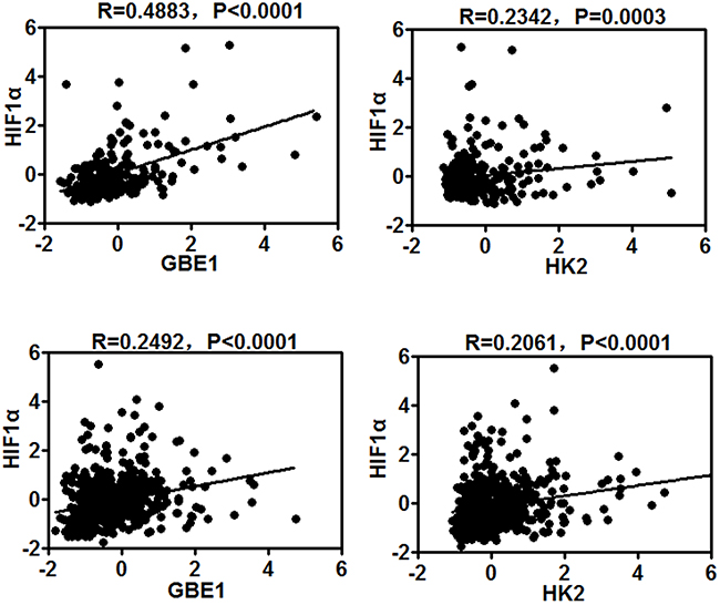 GBE1 and HK2 expression is associated with HIF1&#x03B1; in lung adenocarcinoma and squamous carcinoma patients.