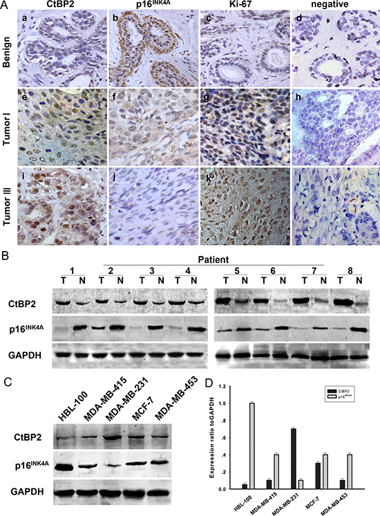 Expression of CtBP2 and p16INK4A in human breast cancer.