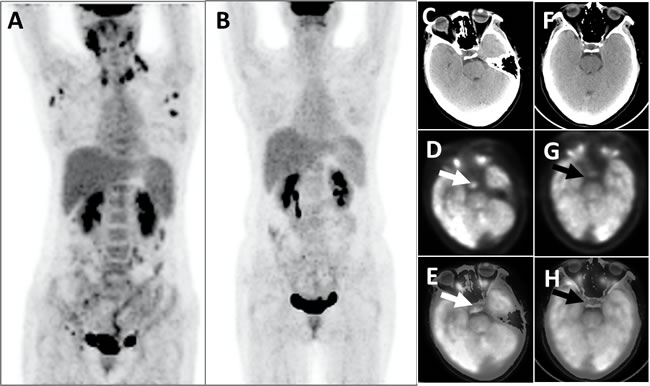 This patient with LCH developed multiple hypermetabolic lymph nodes, which disappeared after chemotherapy.