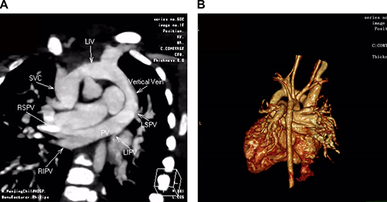 CT angiography in a 5-month-old girl with supracardiac total anomalous pulmonary venous connection (TAPVC) and unrestrictive ASD.