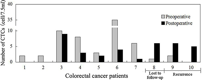 Comparison of preoperative and postoperative one week (P1W) CTCs to predict tumor recurrence in colorectal cancer patients.