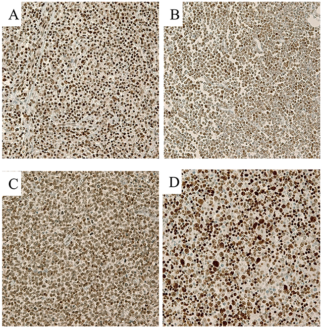 Representative immunohistochemical stains in T cell lymphoma samples (400&#x00D7;).
