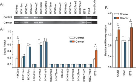 Fig 2: Characteristic histone modification and ETS1 factors enrichment patterns around the hypomethylated ETS1 motif in BRCA1-mutated ovarian cancer.