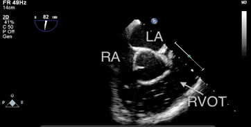 Bubbles filling the RA and RVOT were detected by TEE in one patient in the S group during hepatic parenchymal resection.
