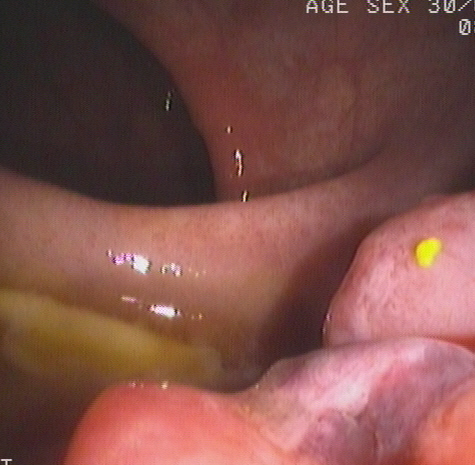 Image from colonoscopy demonstrating a lump-type lesion with a wide base and rough surface in the rectum near the dentate line.