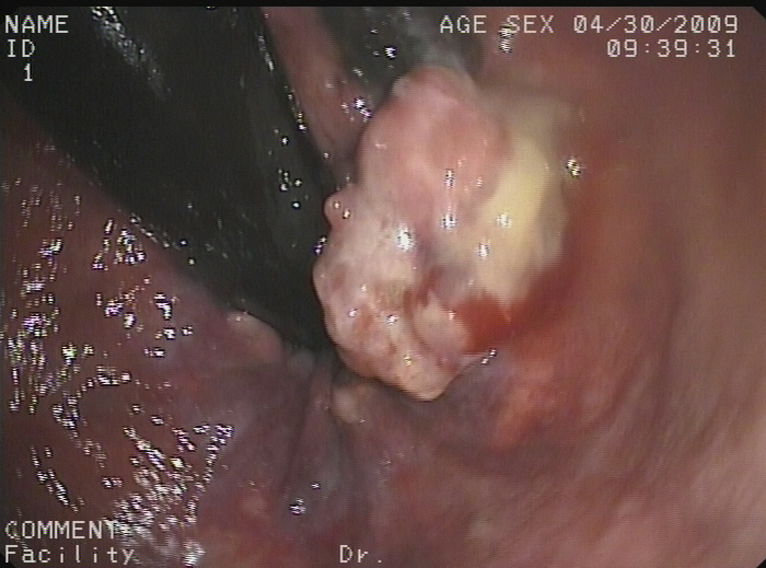 Image from colonoscopy revealing a lump-type lesion with a rough surface and black patches projecting from the mucous membrane near the dentate line.