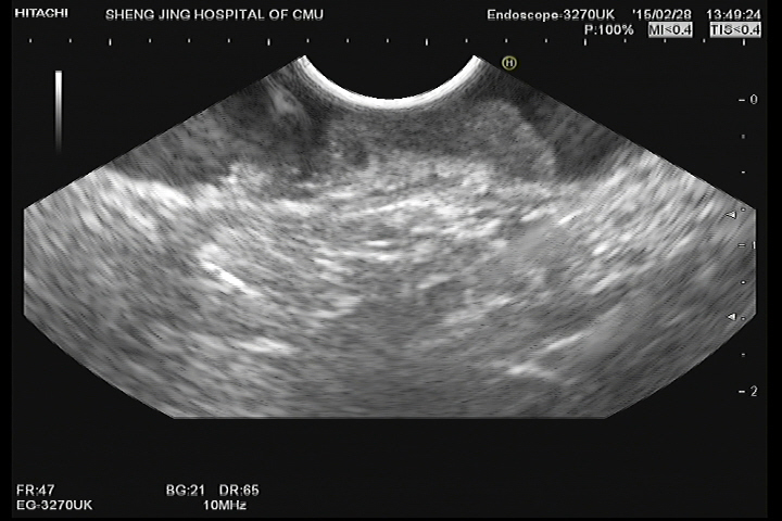 Image from EUS obtained for evaluation of a lesion identified on colonoscopy.