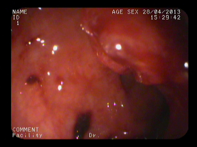 Image from colonoscopy demonstrating a lump-type lesion near the dentate line with a wide base and rough surface.