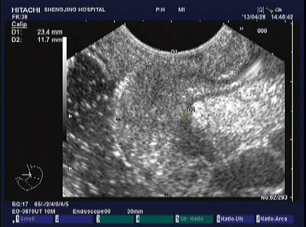 Image from EUS performed in the same patient revealing abnormally thickened and hypoechoic mucosa and submucosa.