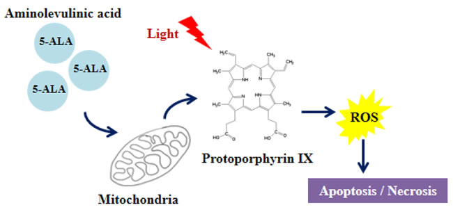 5-ALA-PDT