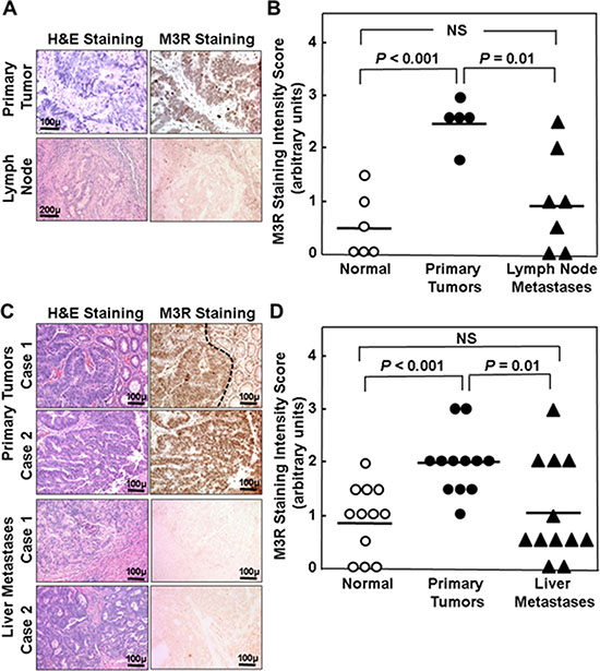 Relative M3R immunostaining in primary adenocarcinoma compared to lymph node and liver metastases from the same patient.