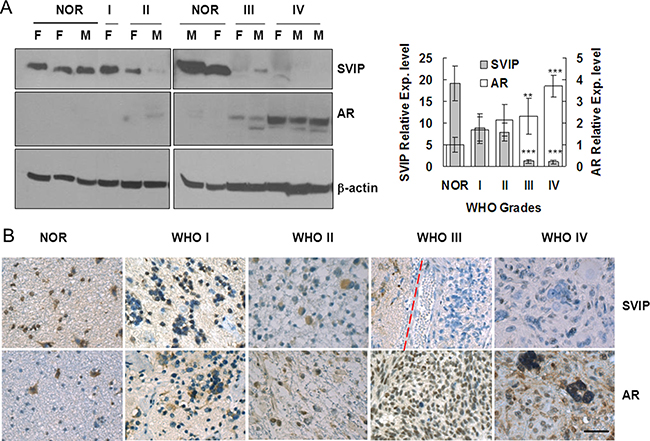 AR expression is increased, but SVIP expression is reduced in glioma samples compared with normal brain tissues.