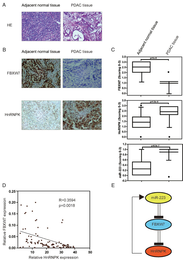Low FBXW7 is tightly correlated with higher miR-223 and hnRNPK levels in human PDAC tissues.