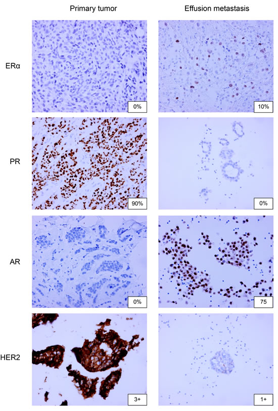 ER&#x3b1;, PR, AR and HER2 immunohistochemistry on paired primary breast tumors and pleural or peritoneal metastases.