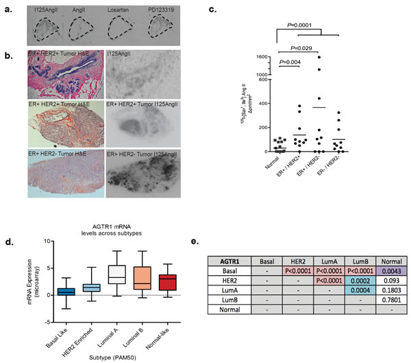 Expression of AT1R is increased in invasive breast cancer.