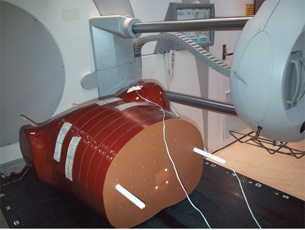 Setup of breast CBCT dose measurement using a female-configured anthropomorphic phantom and MOSFET detectors.