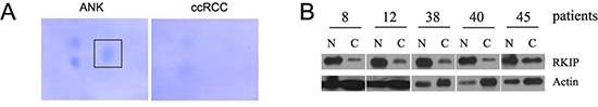 Reduction of RKIP in ccRCC.