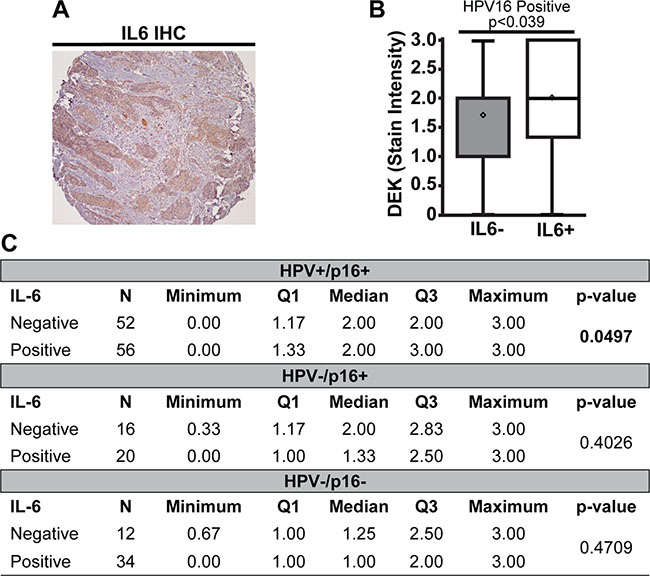 High DEK expression was associated with IL6 expression in HPV16+ tumors.