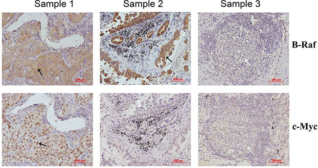 Expression of B-Raf and c-Myc proteins in human NSCLC samples.