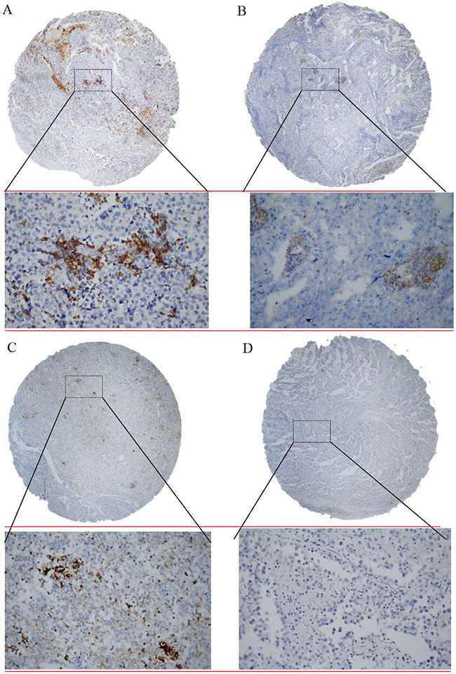 Immunohistochemical detection of programmed death-cell ligand 1 (PD-L1) expression in tumor infiltrating lymphocytes in testicular germ cell tumors.