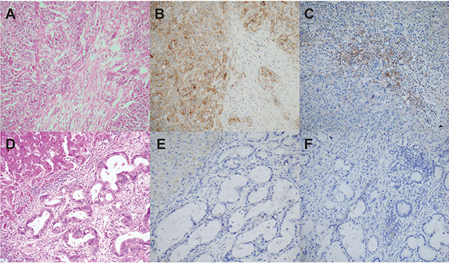PD-L1 expression in cholangiocarcinoma.