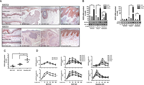 SOCS3 and SOCS1 are poorly expressed in the epidermis of NMSC lesions and are not induced in transformed keratinocytes by IL-22.