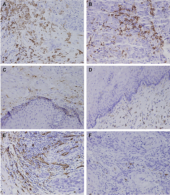 The distribution of CD163-positive M2 macrophae and microvessel in Kazakh esophageal squamous cell carcinoma (ESCC) and Cancer adjacent normal (CAN) tissues.