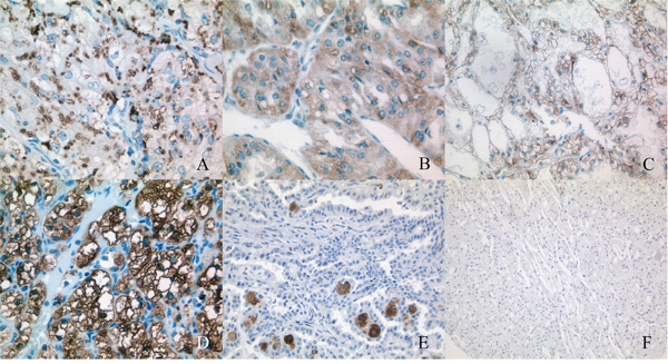 Staining patterns of the adipophilin in renal cell carcinoma (RCC).