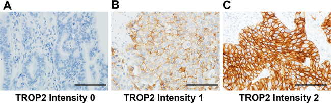 Immunohistochemical evaluation of membranous TROP2 expression in tumor cells from patients with lung adenocarcinoma.