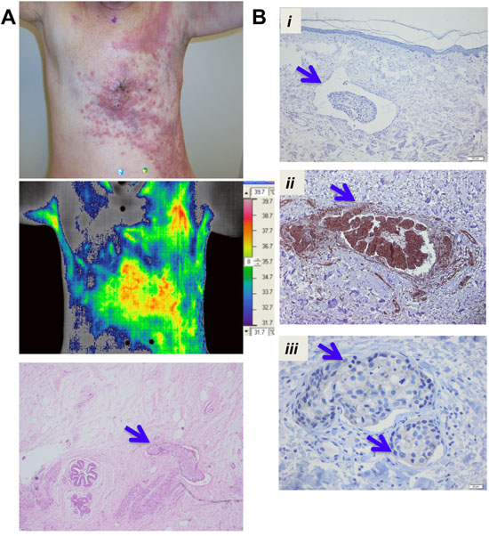 XIAP and NF&#x03BA;B expression in tumor emboli in IBC patient samples.