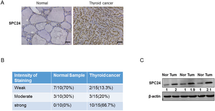 SPC24 was high expressed in human thyroid cancer samples.