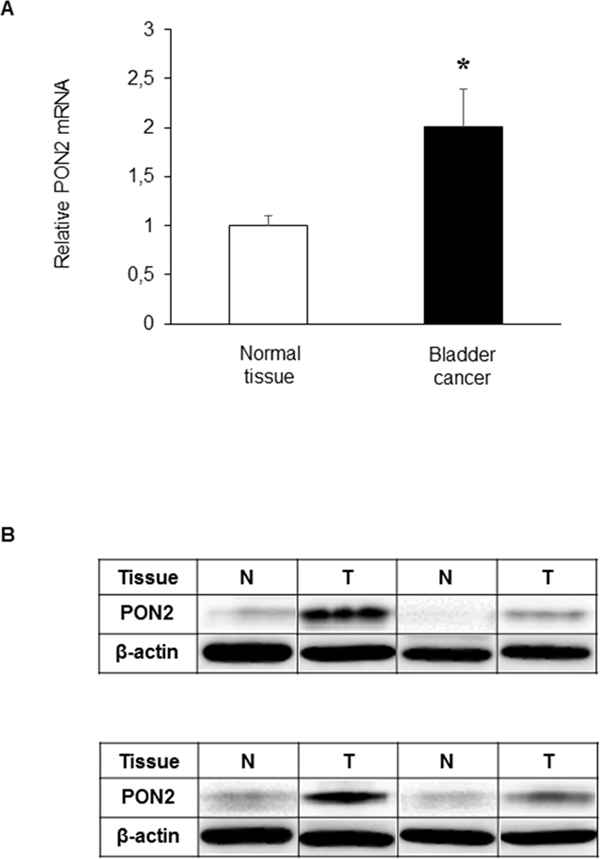 PON2 expression in bladder tissue.