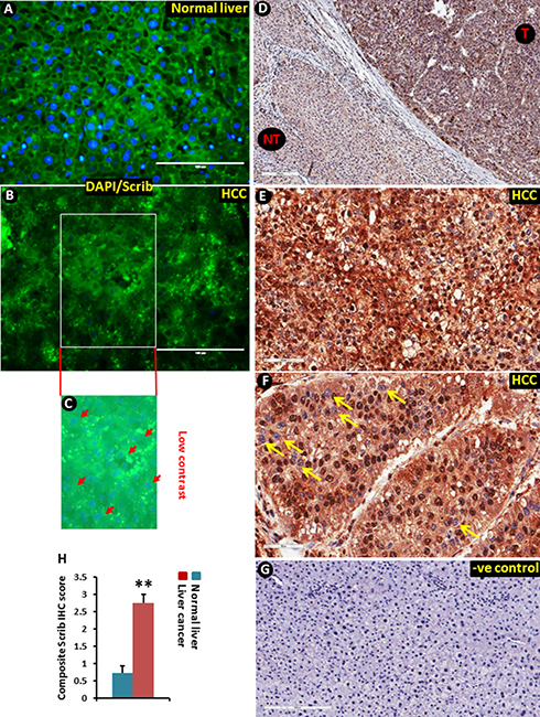 Translocation of Scrib to the nucleus in human liver tumor tissues.