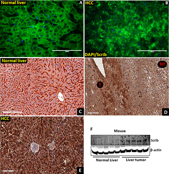 Translocation of Scrib to the nucleus in mouse liver tumor tissues.