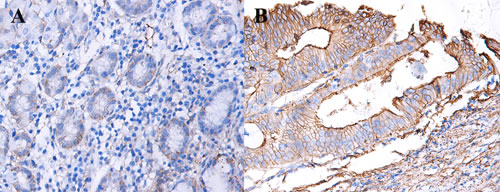 Expression of CD147 in GC and adjacent non-tumor tissues.