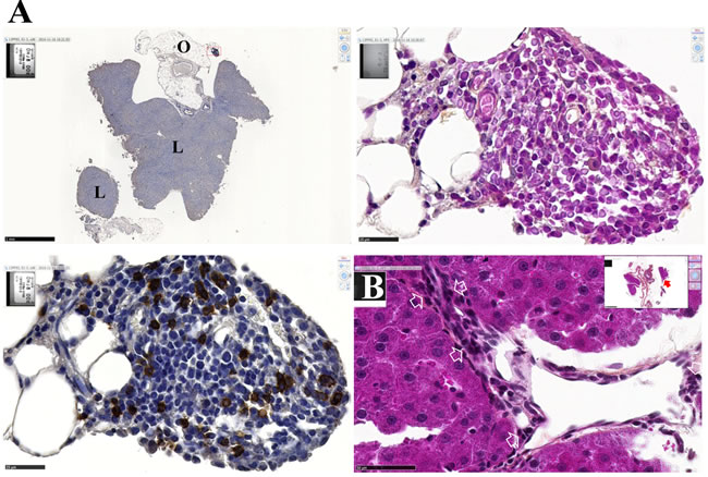 Morphological changes of residual tumor cells in contact with activated lymphocytes.