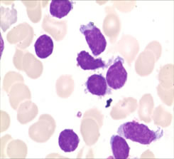 Figure 1:The neoplastic lymphoid cells in bone marrow aspirates with irregularly shaped nuclei, a moderate amount of cytoplasm, and large cytoplasmic granules.