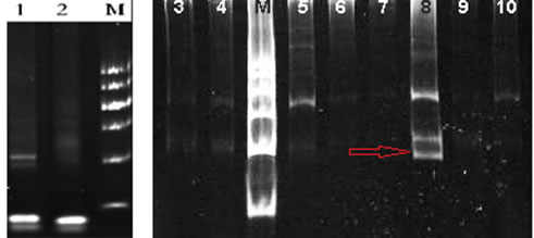 TCR gene rearrangement test in our hospital: TCR gene rearrangement by PCR was positive for TCR &#x3b2; and &#x3b3; (red arrow, lane 8).