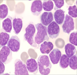 Cerebrospinal fluid test: massive amount of cytoplasm and large cytoplasmic granules, with irregular shaped nuclei in cerebrospinal fluid.