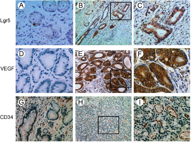 Immunohistochemical staining of Lgr5, VEGF and CD34 in gastric carcinoma and normal mucosa tissues.