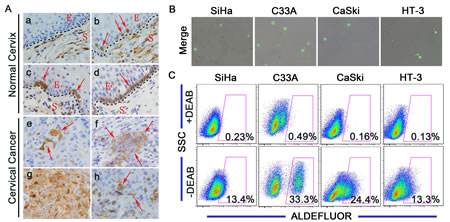 ALDH expression in human cervical tissue specimens and cervical cancer cell lines.